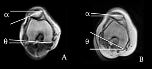(A) lateral tilt of the patella during non-weight bearing; (B) femoral IR altering the contact area during weight-bearing.