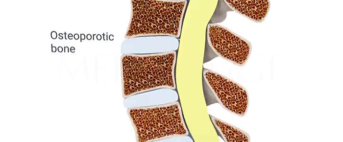 Peak Bone Mass: Three Factors Impacting the Risk of Osteoporosis