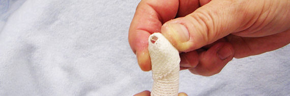 mallet finger casting