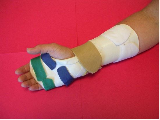 A hand and arm are shown from the elbow down. The arm is position with the wrist facing up. The wrist and hand are in a splint used to stabilize for carpal tunnel syndrome.